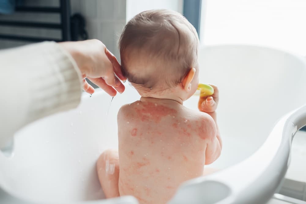 Dermatitis Atopik Anak Sering Kambuh: Mengapa Perawatan Skin Barrier Tidak Boleh Disepelekan