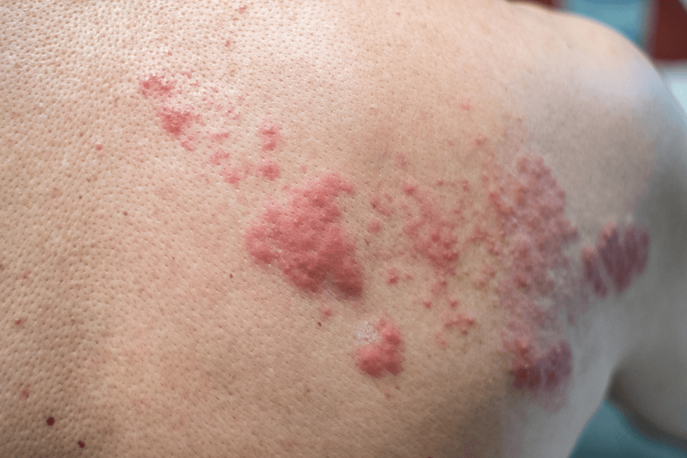 Mengapa Pencegahan Herpes Zoster Penting di Masyarakat?