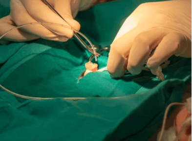 Umbilical Venous Catheterization (UVC)