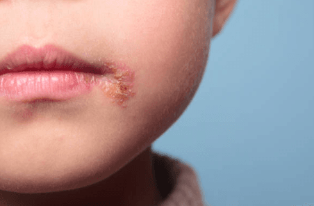 Herpes Simplex pada Anak