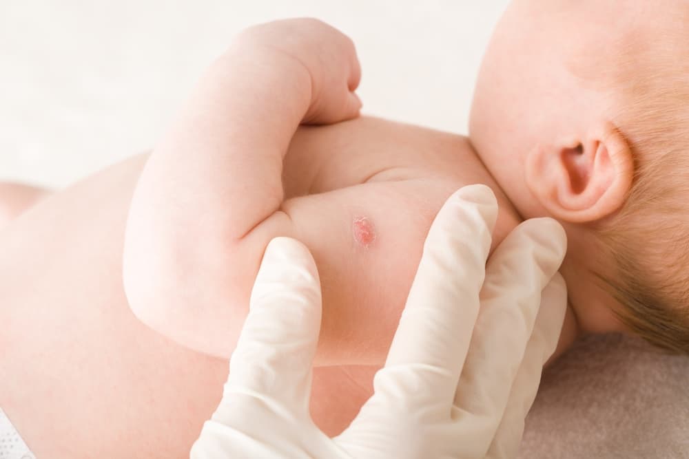 Vaksin BCG untuk Mencegah Tuberkulosis pada Anak: Jadwal, Efektivitas, dan Respons Pascaimunisasi