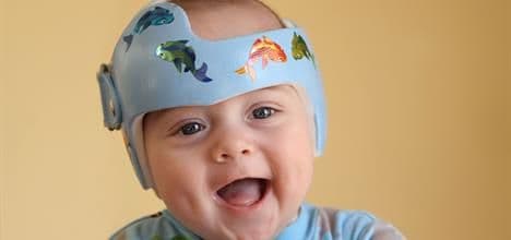 Plagiocephaly: Pentingnya Deteksi Dini dan Tatalaksana yang Tepat