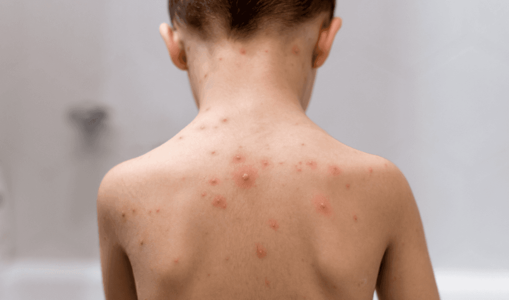 Ini Cara Membedakan HFMD dan Varicella pada Anak