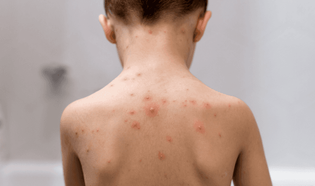 Ini Cara Membedakan HFMD dan Varicella pada Anak