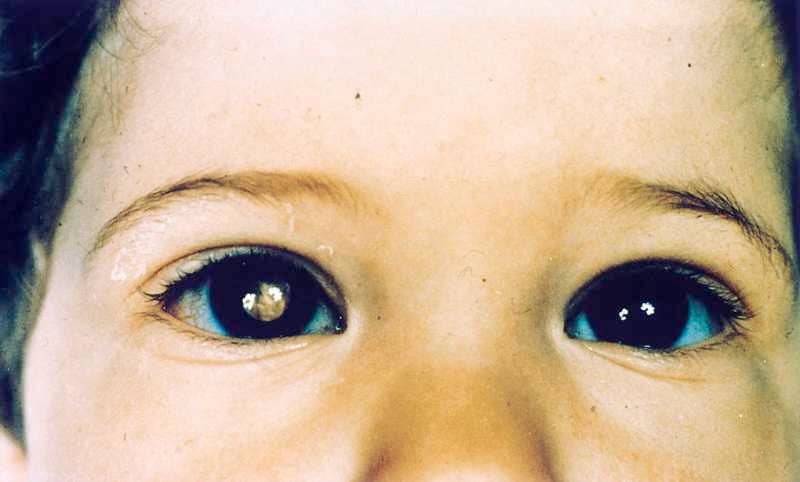 Pentingnya Diagnosis Dini pada Retinoblastoma