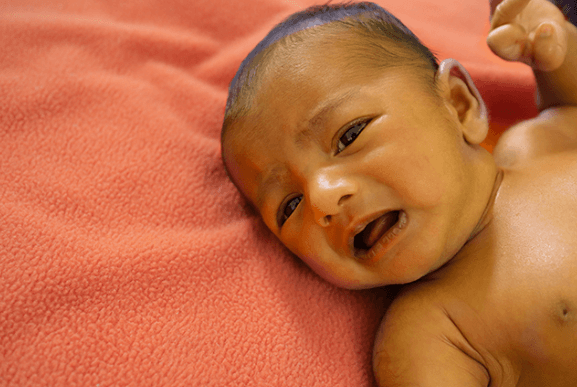 Crigler-Najjar Syndrome: Salah Satu Penyebab Ikterus pada Neonatus