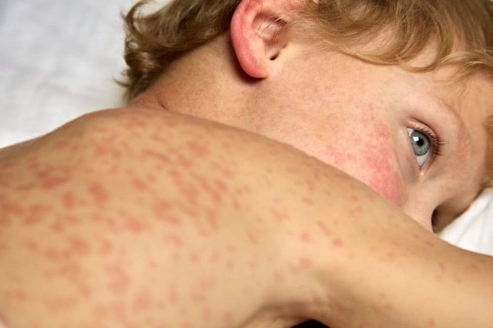 Campak, Rubella, dan Roseola: Bagaimana Cara Membedakannya?