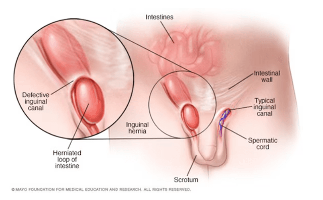Hernia Inguinalis pada Anak: Pendekatan Diagnosis dan Tatalaksana Komprehensif bagi Dokter Anak
