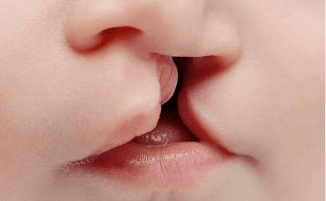 Peran Dokter Anak dalam Penatalaksanaan Bibir Sumbing
