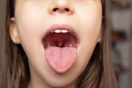 Difteri pada Anak: Tinjauan Klinis dan Strategi Manajemen