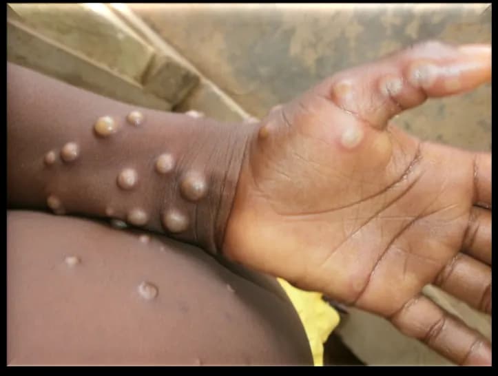 Vaksin Mpox Sedang dalam Tahap Prekualifikasi WHO
