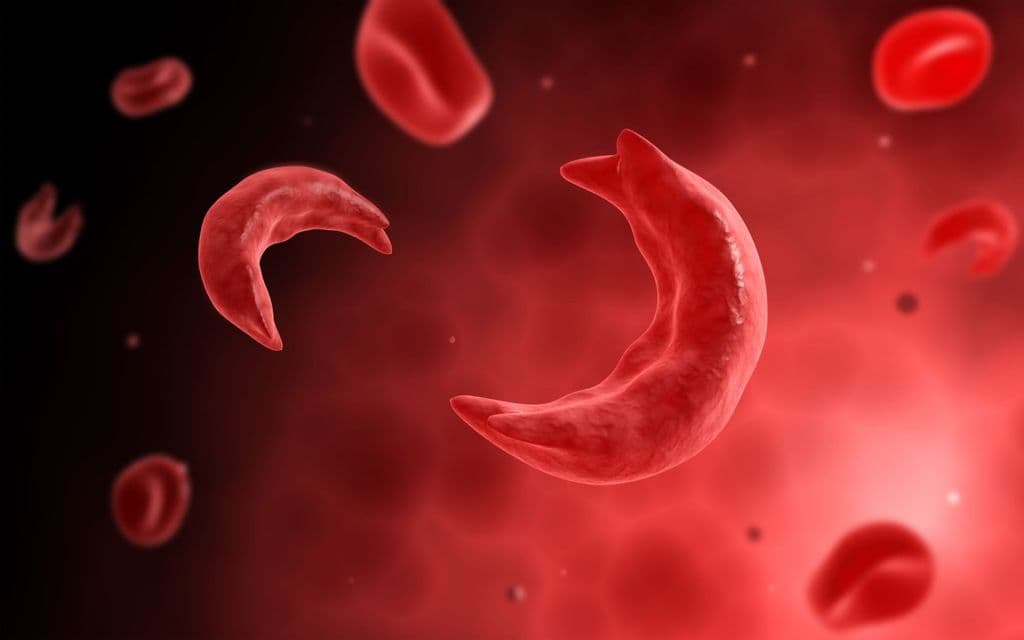 Seputar Sickle cell anemia