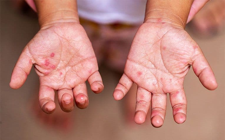 Apakah Hand, Foot, and Mouth Disease?