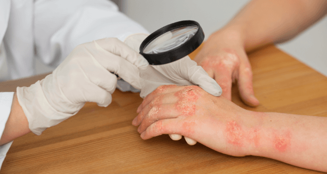 Diagnosis dan Klasifikasi Kusta