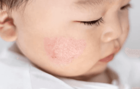 Dermatitis Atopik pada Anak Berdasarkan Pedoman PERDOSKI