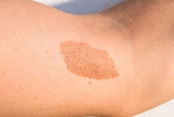Neurofibromatosis Tipe 1 pada Anak: Pendekatan Diagnostik dan Tatalaksana