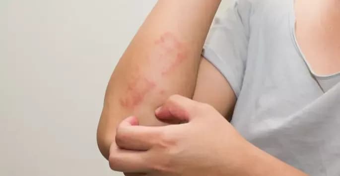 Psoriasis pada Anak: Tinjauan untuk Dokter Anak
