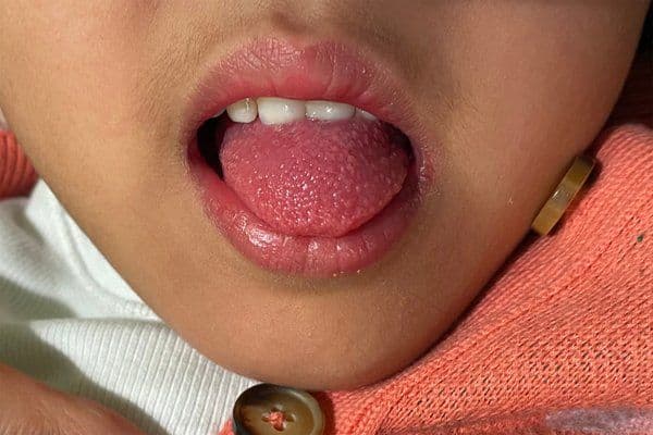 Apakah Scarlet Fever dan Bagaimana Mengatasinya?