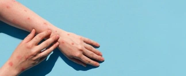 Berikut Hal-Hal Penting yang Perlu Diketahui Mengenai Mpox Sebagai Dokter Anak
