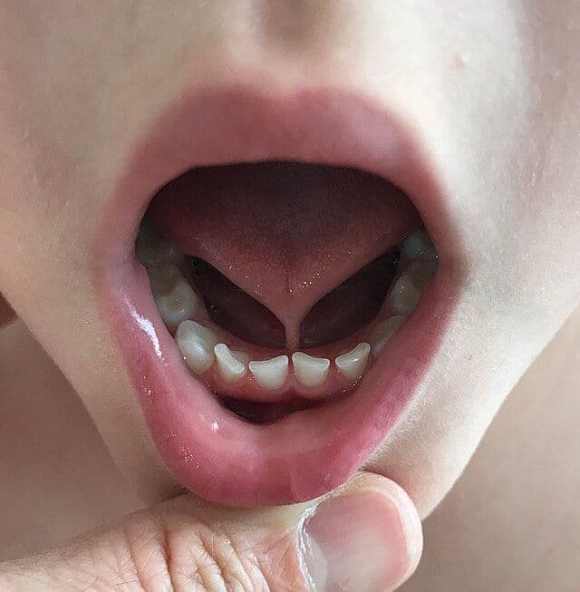 Tatalaksana Ankyloglossia pada Bayi Berdasarkan Rekomendasi IDAI