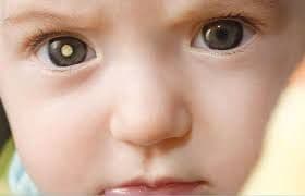 Retinoblastoma: Diagnosis dan Tatalaksana