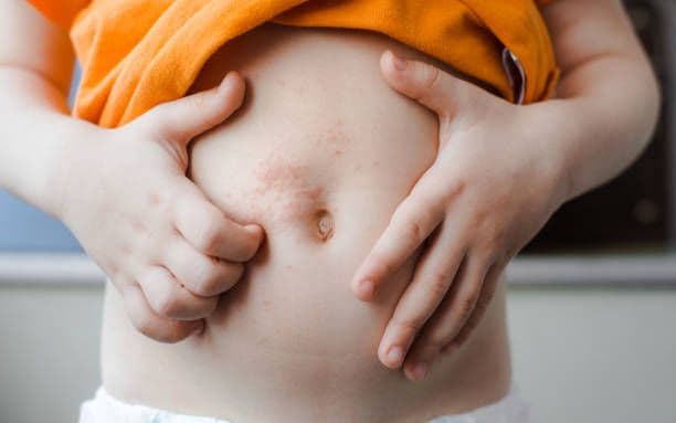 Penanganan Skabies pada Anak-Anak
