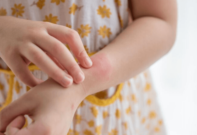 Dermatitis Kontak Alergi pada Anak
