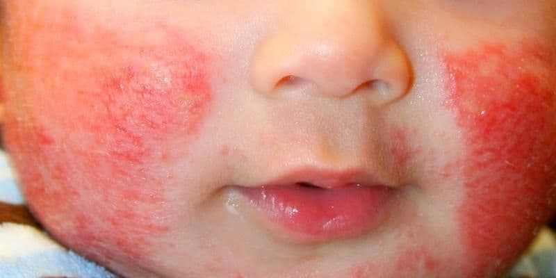 Dermatitis Atopik: Diagnosis dan Tatalaksana