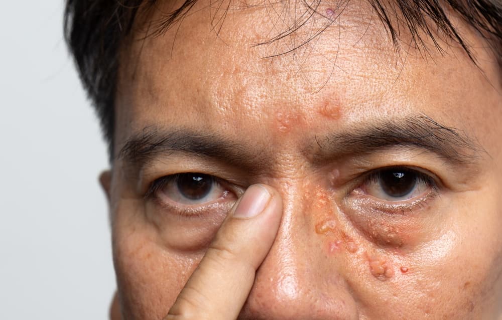 Herpes Zoster Bukan Sekadar Ruam, Bisa Tingkatkan Risiko Metabolik dan Kardiovaskular